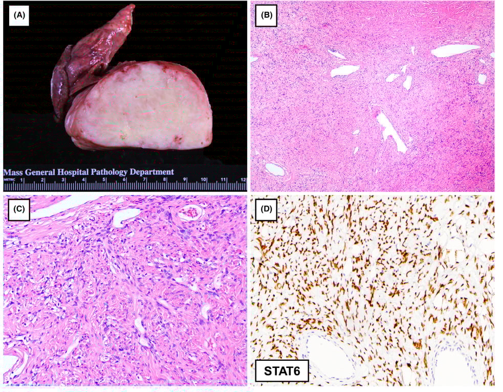 罕见胸膜肿瘤深度解读:一文看懂各类间叶源性肿瘤的病理与基因特征 1 图片