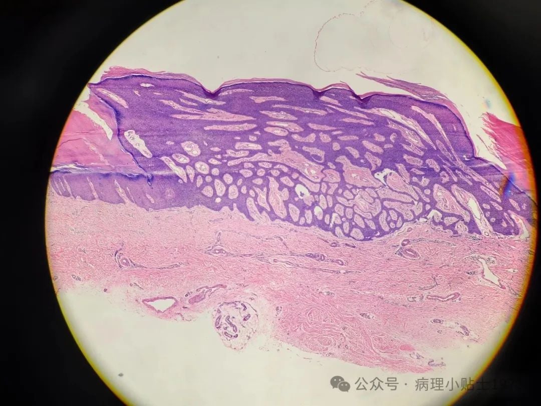 脚底长了结节是癌症吗?一文了解小汗腺汗管纤维腺瘤的诊断与治疗 1 图片