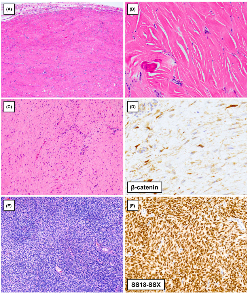 罕见胸膜肿瘤深度解读:一文看懂各类间叶源性肿瘤的病理与基因特征 2 图片