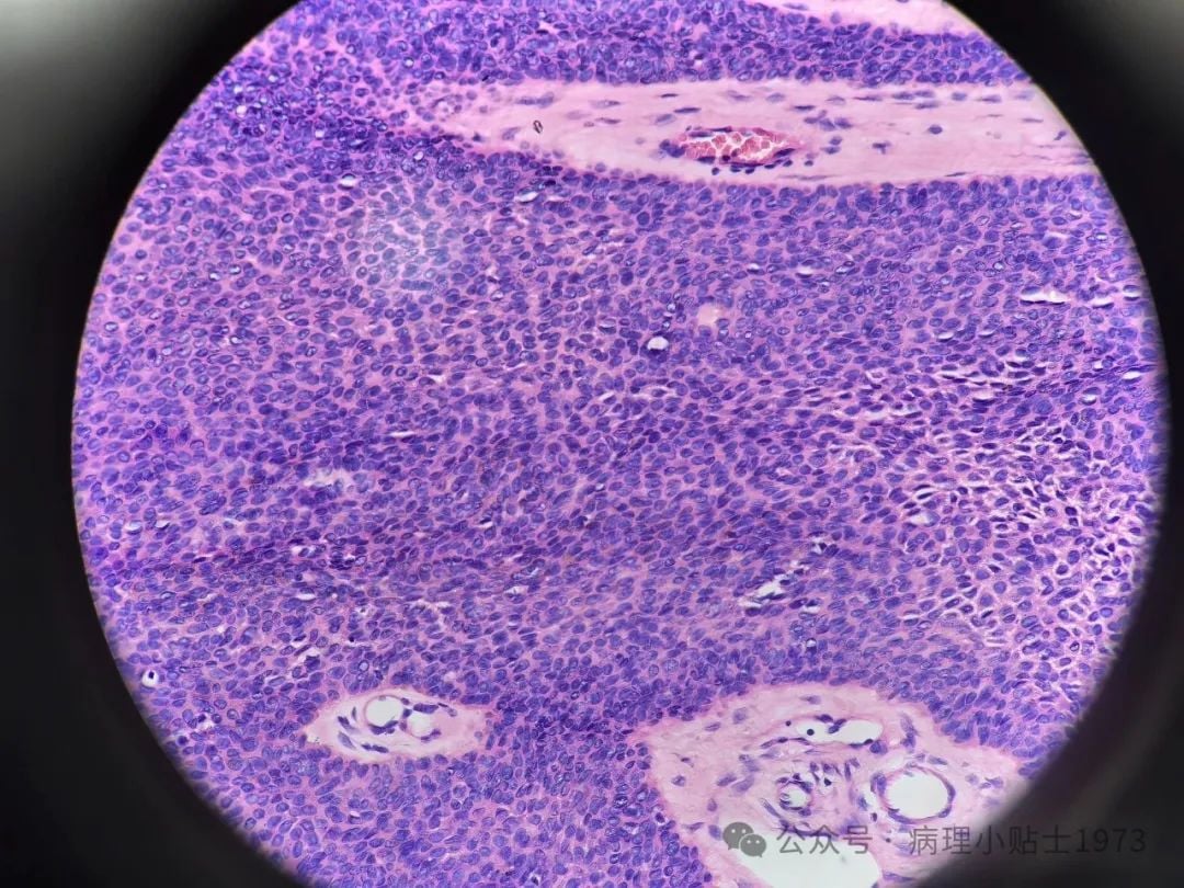 脚底长了结节是癌症吗?一文了解小汗腺汗管纤维腺瘤的诊断与治疗 8 图片