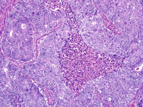 看懂子宫内膜样癌病理报告:FIGO分级与关键基因(PTEN/TP53/MMR)深度解析 4 FIGO 3级子宫内膜样癌