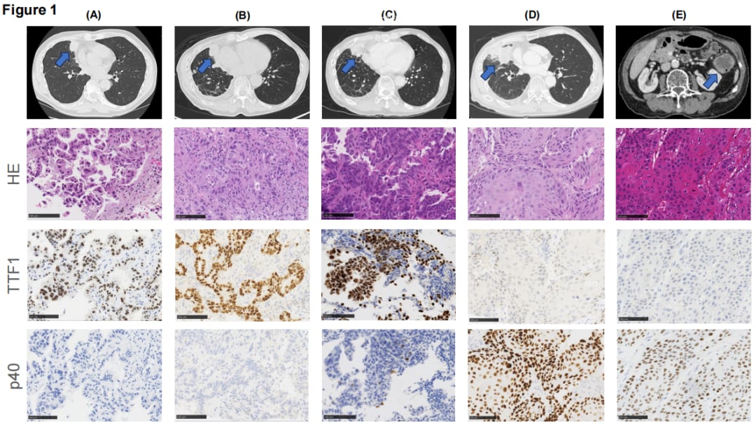EGFR肺腺癌耐药后转化为鳞癌?新研究揭示FGFR1/NSD3扩增是关键 1 图片