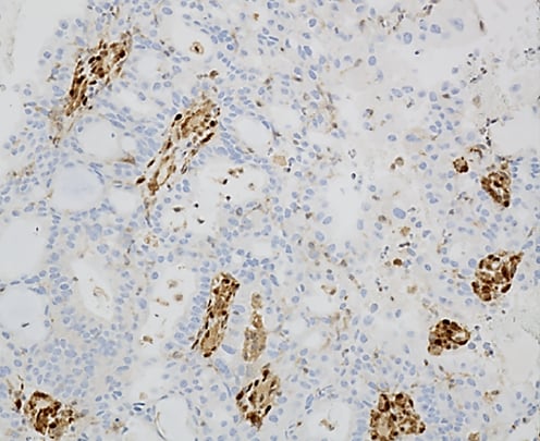 看懂子宫内膜样癌病理报告:FIGO分级与关键基因(PTEN/TP53/MMR)深度解析 5 PTEN表达丢失