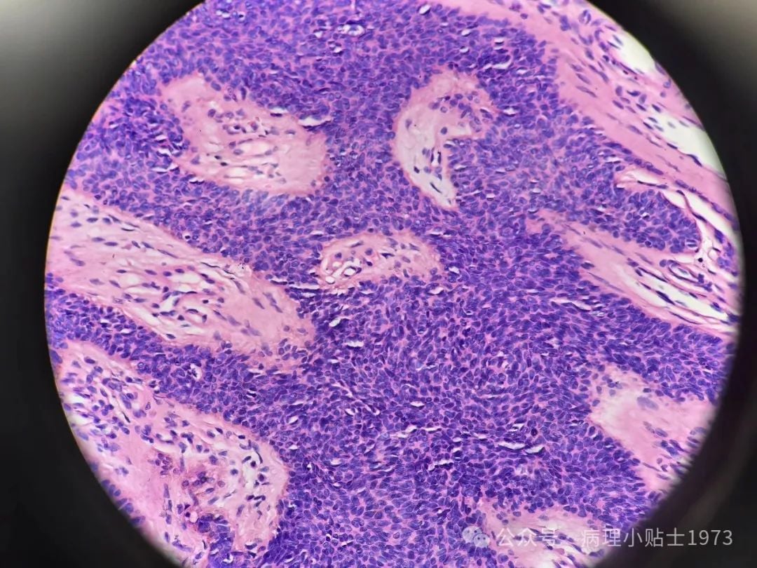 脚底长了结节是癌症吗?一文了解小汗腺汗管纤维腺瘤的诊断与治疗 4 图片