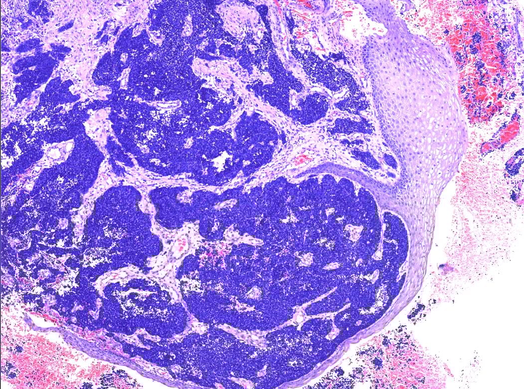 深度解读宫颈小细胞神经内分泌癌:从病例看诊断与治疗前景 1 肿瘤位于正常宫颈鳞状上皮下方