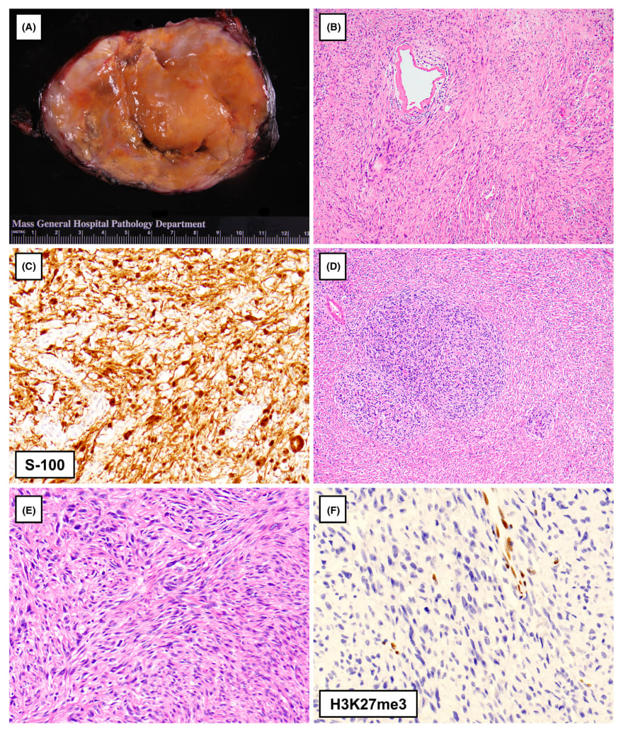 罕见胸膜肿瘤深度解读:一文看懂各类间叶源性肿瘤的病理与基因特征 3 图片