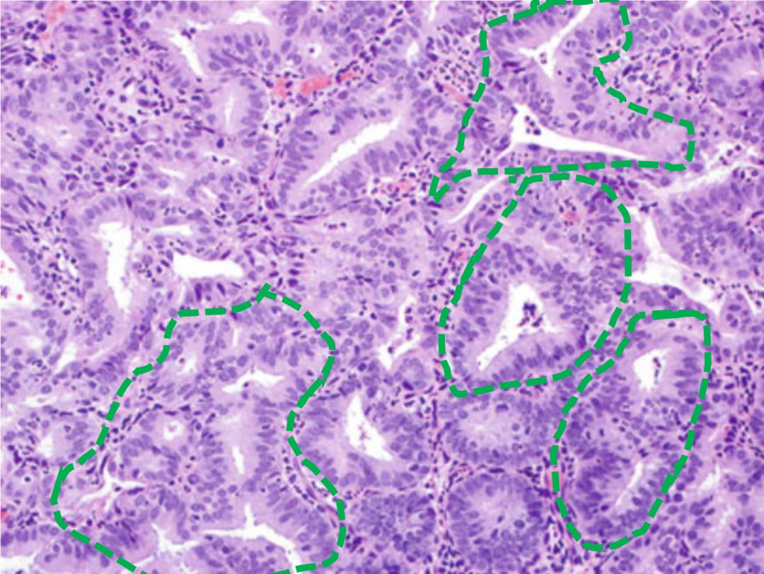 看懂子宫内膜样癌病理报告:FIGO分级与关键基因(PTEN/TP53/MMR)深度解析 2 背靠背结构