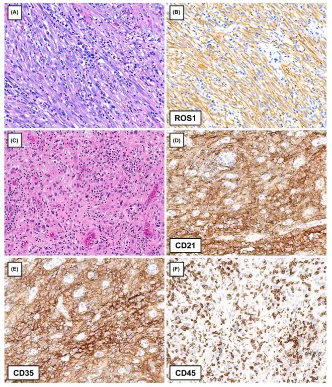 罕见胸膜肿瘤深度解读:一文看懂各类间叶源性肿瘤的病理与基因特征 4 图片
