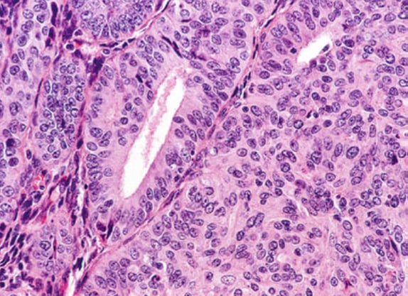 看懂子宫内膜样癌病理报告:FIGO分级与关键基因(PTEN/TP53/MMR)深度解析 3 中度异型细胞核