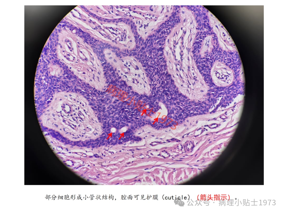 脚底长了结节是癌症吗?一文了解小汗腺汗管纤维腺瘤的诊断与治疗 13 图片