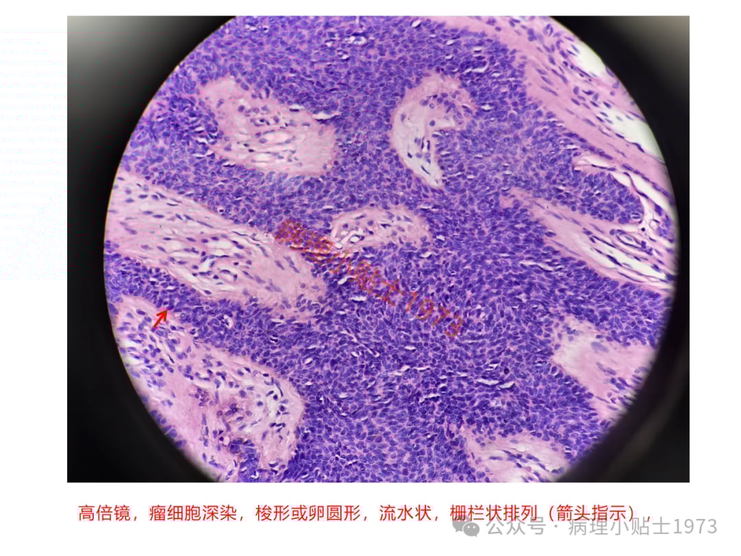 脚底长了结节是癌症吗?一文了解小汗腺汗管纤维腺瘤的诊断与治疗 12 图片