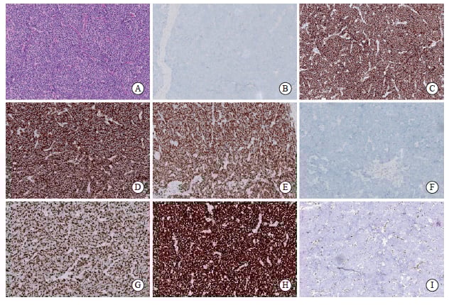 食管小细胞癌生存率有多高?最新研究对比手术与放化疗效果,揭示最佳治疗策略 1 图片