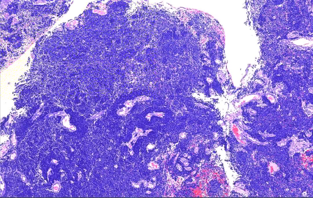 深度解读宫颈小细胞神经内分泌癌:从病例看诊断与治疗前景 2 肿瘤细胞弥漫性浸润宫颈间质