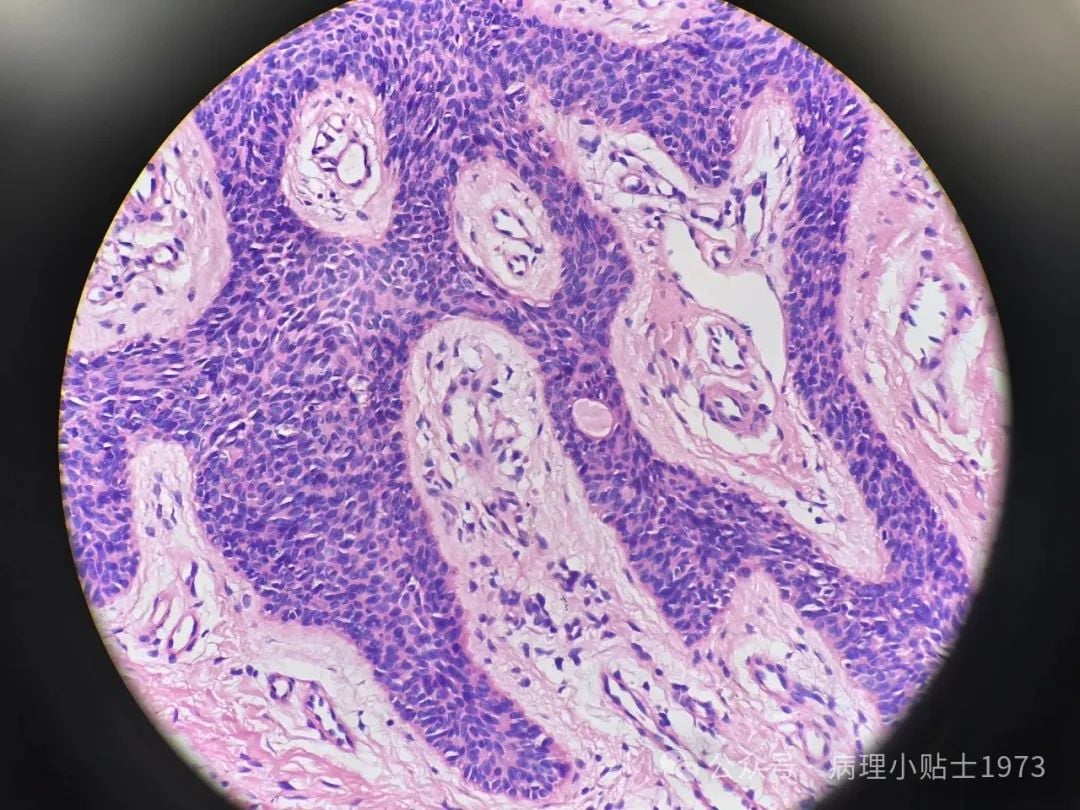 脚底长了结节是癌症吗?一文了解小汗腺汗管纤维腺瘤的诊断与治疗 7 图片