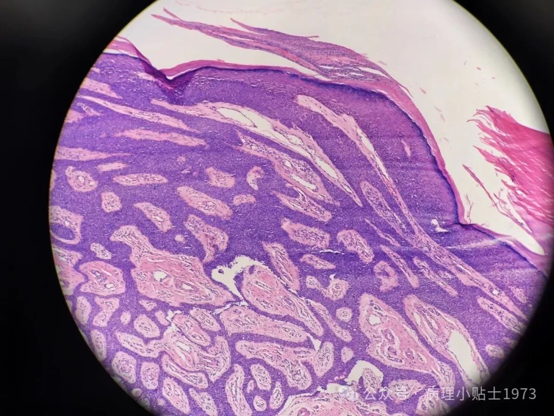 脚底长了结节是癌症吗?一文了解小汗腺汗管纤维腺瘤的诊断与治疗 3 图片