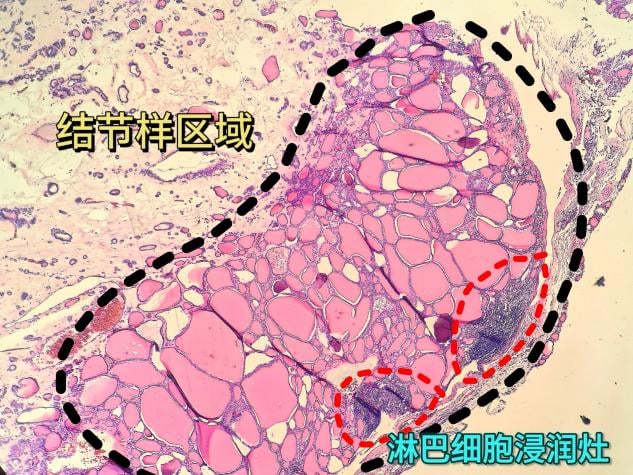 甲状腺滤泡结节性病变是癌吗?一文读懂病理报告与甲状腺癌的区别 3 image.png