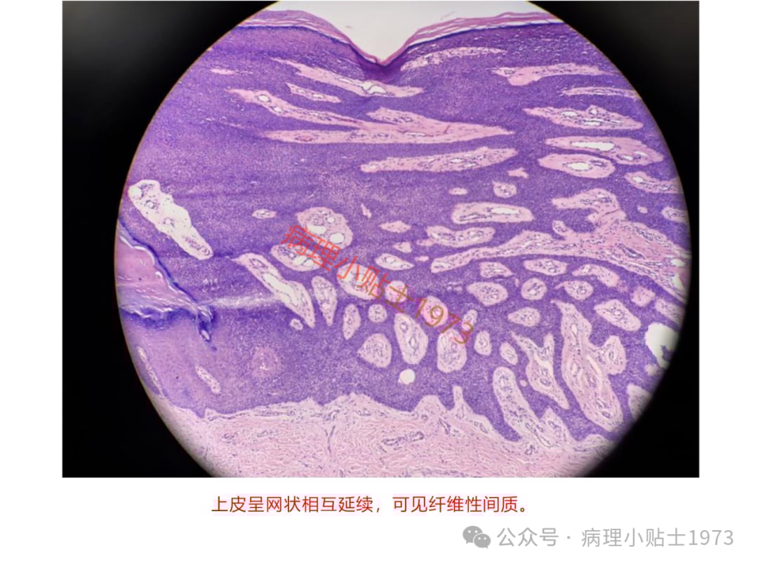 脚底长了结节是癌症吗?一文了解小汗腺汗管纤维腺瘤的诊断与治疗 10 图片