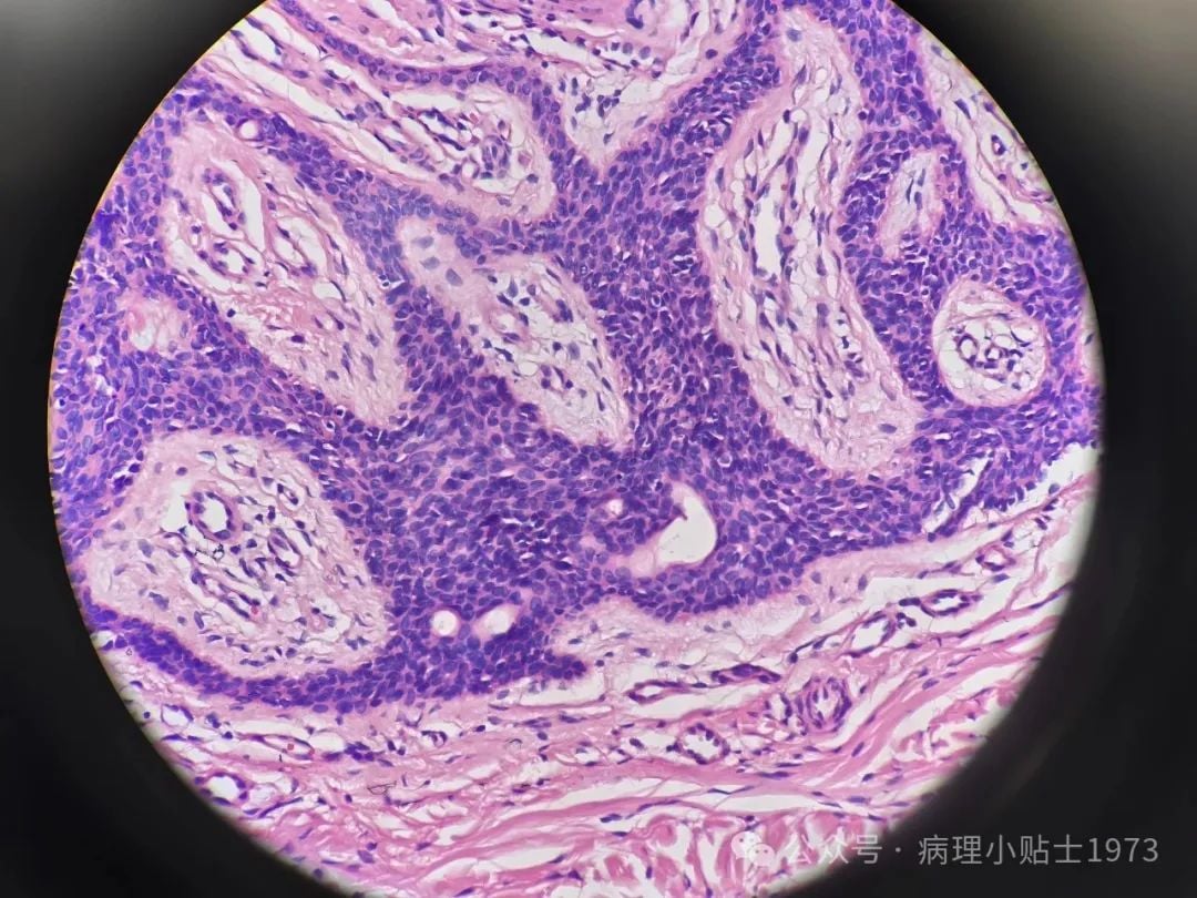 脚底长了结节是癌症吗?一文了解小汗腺汗管纤维腺瘤的诊断与治疗 6 图片