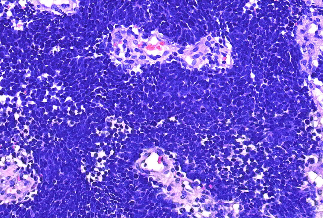 深度解读宫颈小细胞神经内分泌癌:从病例看诊断与治疗前景 3 高倍镜下的肿瘤细胞特征