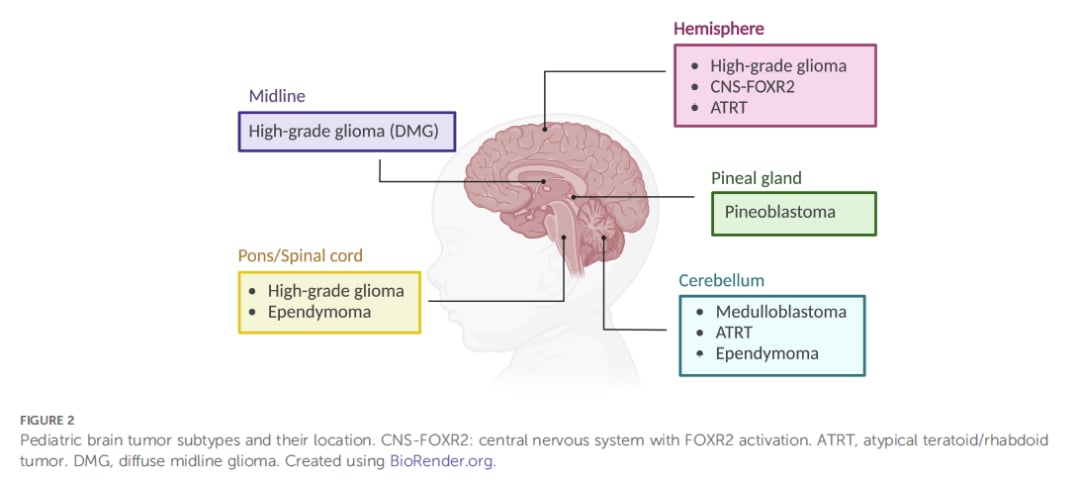 MYCN基因扩增:儿童脑肿瘤的“幕后黑手”与靶向治疗新希望 3 图片