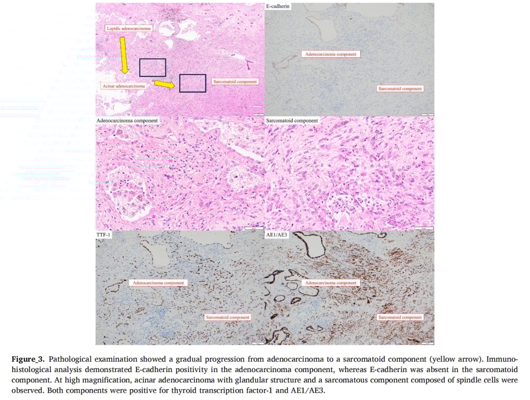 罕见肺多形性癌十年无复发:磨玻璃结节诊断挑战与治疗策略解析 4 图片