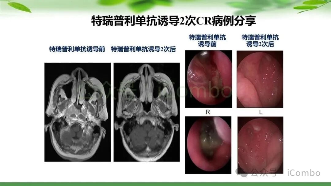 鼻咽癌治疗新篇章:PD-1单抗联合放疗,如何优化策略提升患者生存率? 26 图片