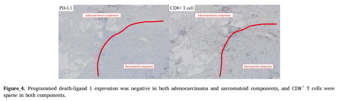 罕见肺多形性癌十年无复发:磨玻璃结节诊断挑战与治疗策略解析 5 图片