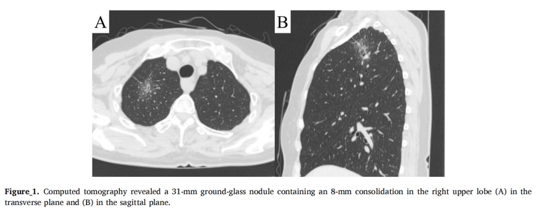 罕见肺多形性癌十年无复发:磨玻璃结节诊断挑战与治疗策略解析 2 图片
