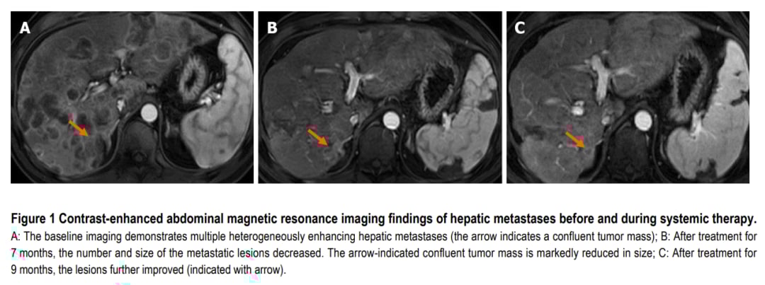 晚期胰腺癌肝转移患者的精准治疗:BRCA2突变与奥拉帕利联合方案的突破 1 图片