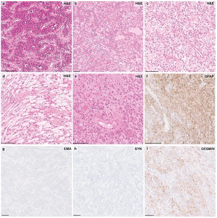 PLAG1融合:中枢神经系统胚胎性肿瘤分子分型新突破,揭示潜在靶点 9 图片