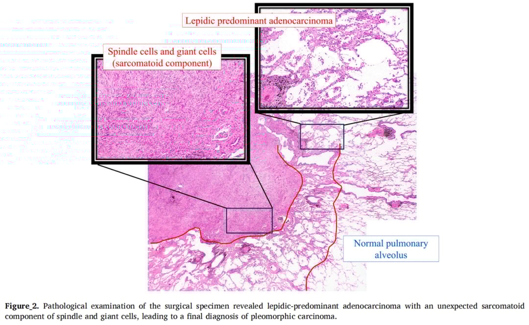 罕见肺多形性癌十年无复发:磨玻璃结节诊断挑战与治疗策略解析 3 图片