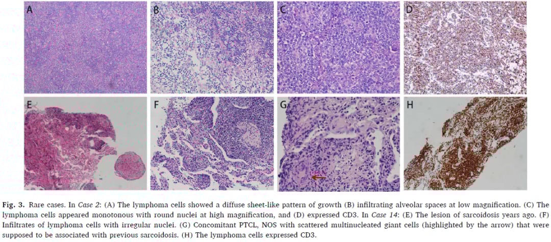 肺部外周T细胞淋巴瘤诊断挑战:警惕误诊,分子检测与综合评估是关键 9 图片