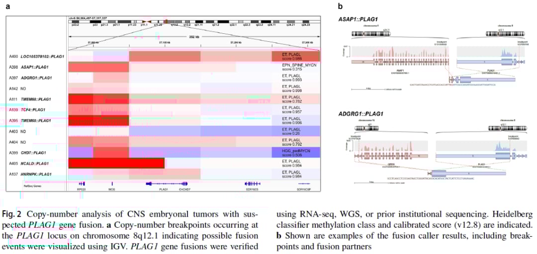 PLAG1融合:中枢神经系统胚胎性肿瘤分子分型新突破,揭示潜在靶点 6 图片