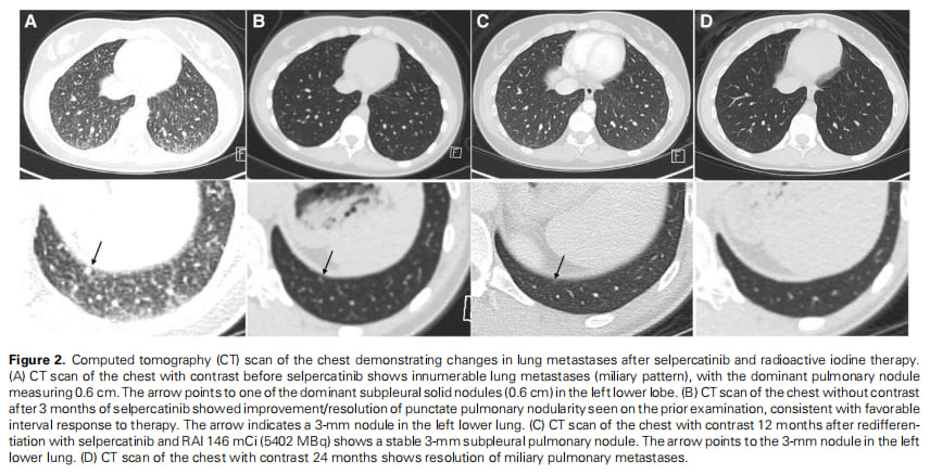 塞普替尼再分化治疗显奇效:RET融合甲状腺癌患者获24个月长期缓解 3 图片