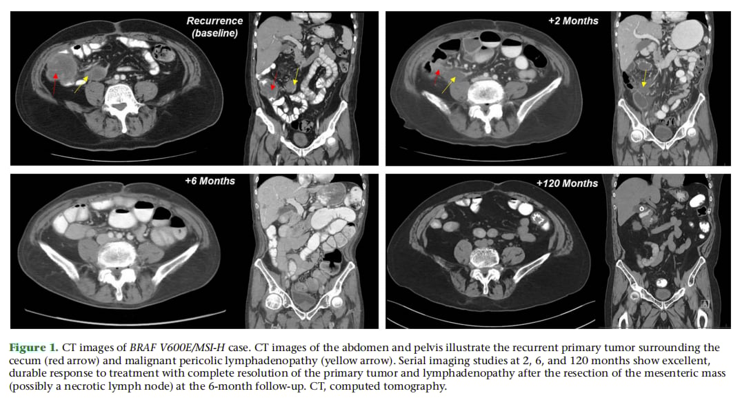 十年完全缓解!靶向药维莫非尼如何攻克BRAF V600E突变结直肠癌? 1 BRAF V600E/MSI-H结直肠癌病例的CT影像