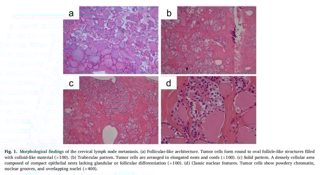 甲状腺癌新发现:SQSTM1::NTRK3罕见融合或成拉罗替尼潜在治疗靶点 1 图片