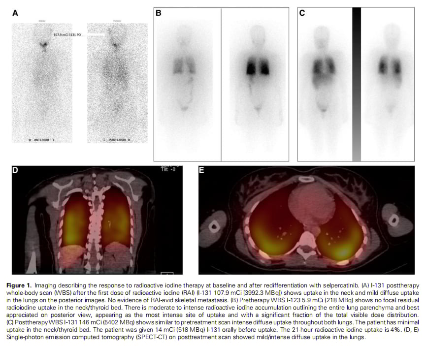 塞普替尼再分化治疗显奇效:RET融合甲状腺癌患者获24个月长期缓解 2 图片