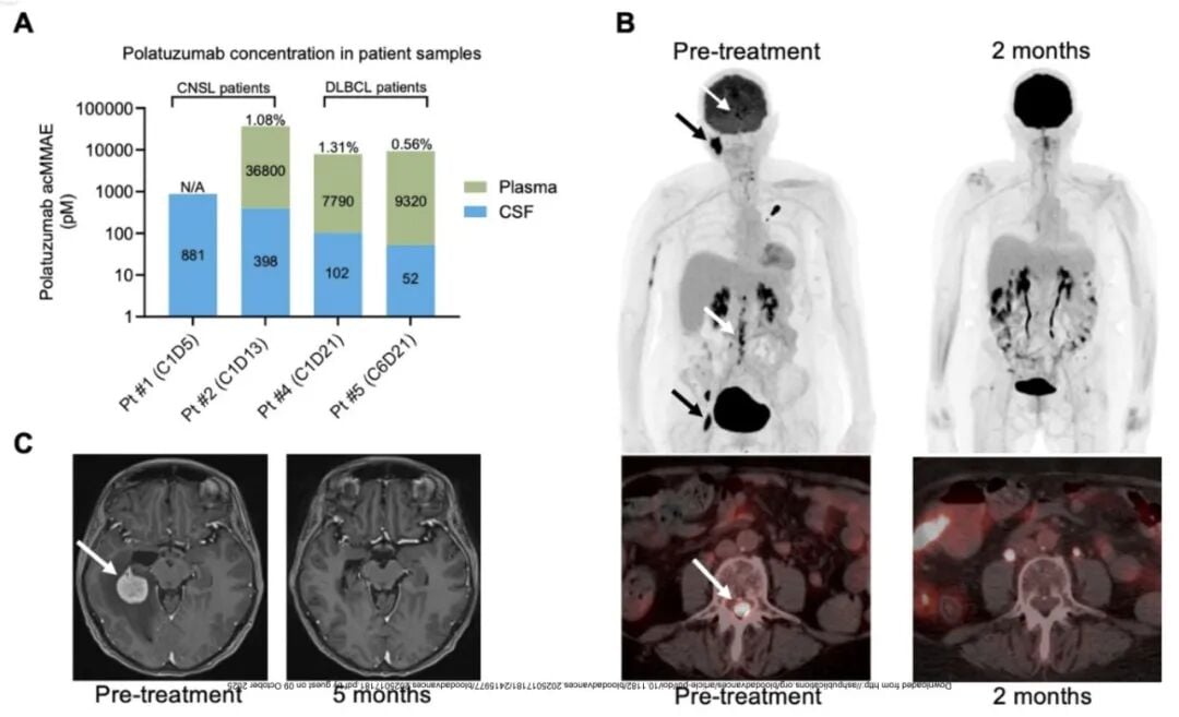 维泊妥珠单抗突破血脑屏障,为中枢神经系统淋巴瘤治疗带来新希望 3 3.jpg