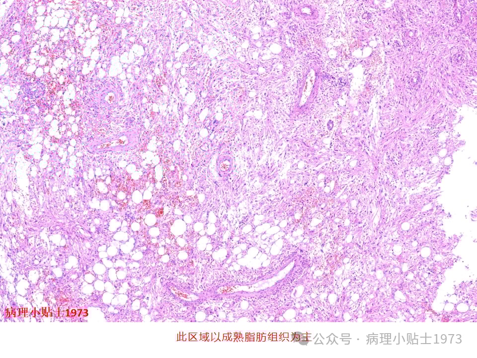 肾脏血管平滑肌脂肪瘤(AML)是什么?一文详解其症状、诊断与TSC基因突变 3 图片