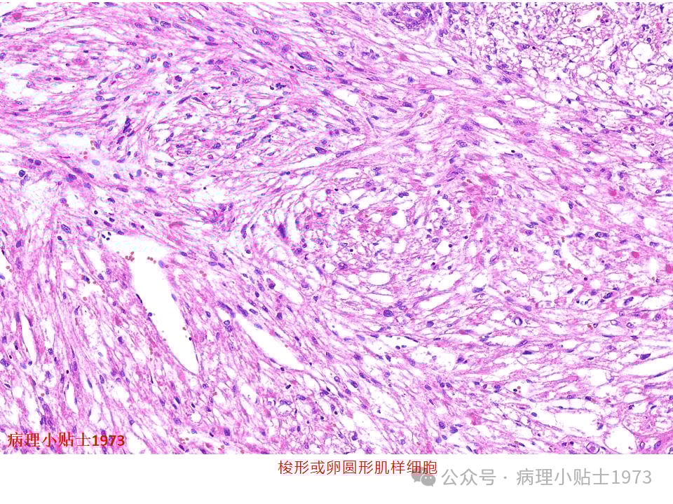肾脏血管平滑肌脂肪瘤(AML)是什么?一文详解其症状、诊断与TSC基因突变 5 图片