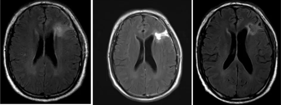 复发胶质母细胞瘤新选择:替尼泊苷联合贝伐珠单抗治疗成功病例解读 3 图片