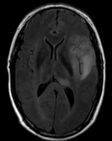 复发胶质母细胞瘤新选择:替尼泊苷联合贝伐珠单抗治疗成功病例解读 2 图片