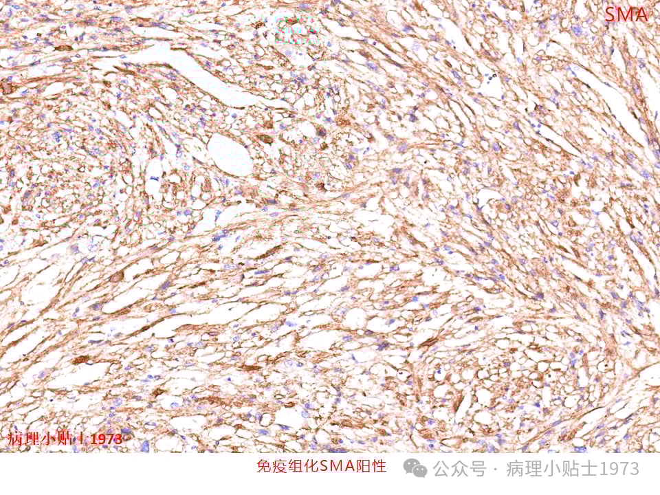 肾脏血管平滑肌脂肪瘤(AML)是什么?一文详解其症状、诊断与TSC基因突变 8 图片