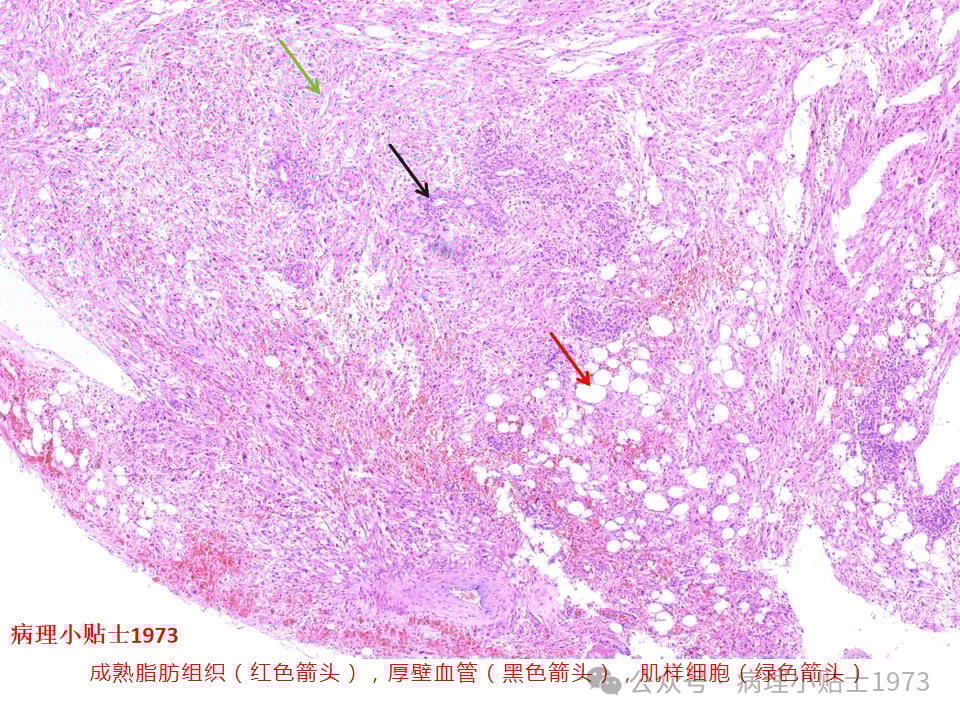 肾脏血管平滑肌脂肪瘤(AML)是什么?一文详解其症状、诊断与TSC基因突变 2 图片