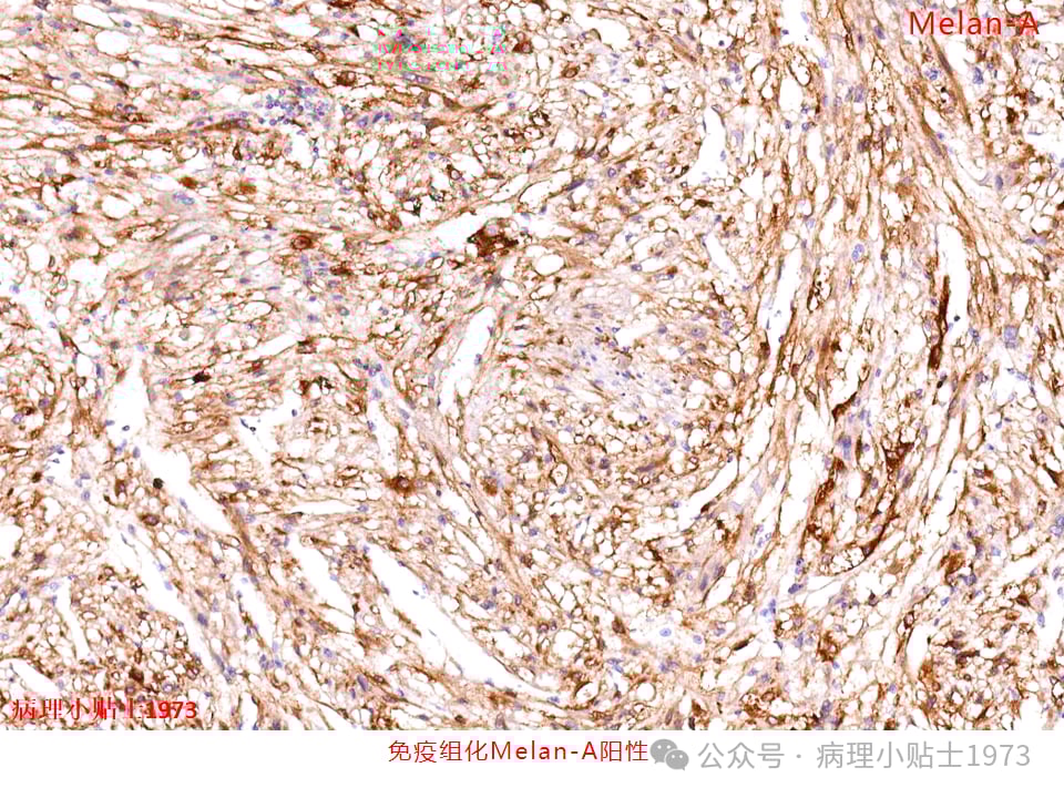 肾脏血管平滑肌脂肪瘤(AML)是什么?一文详解其症状、诊断与TSC基因突变 7 图片
