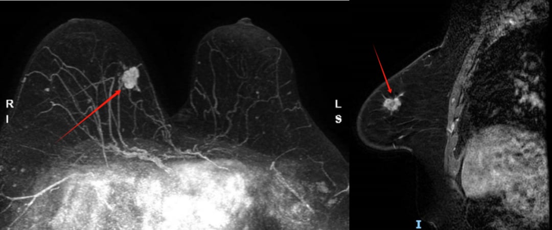 什么是乳腺化生性癌?从一例罕见病例看懂诊断、治疗与预后 1 图片