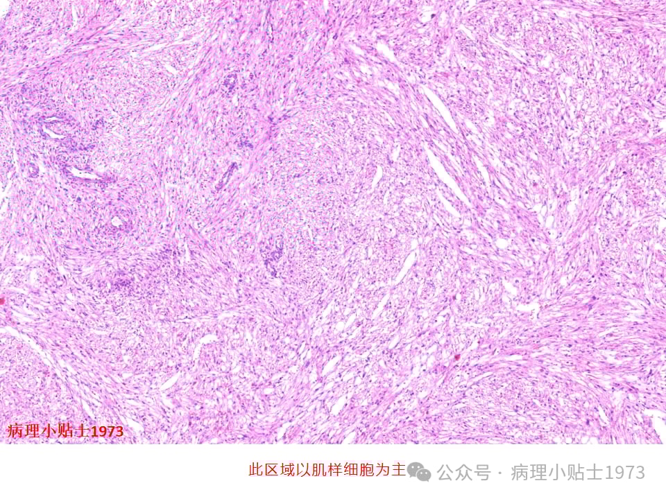 肾脏血管平滑肌脂肪瘤(AML)是什么?一文详解其症状、诊断与TSC基因突变 4 图片