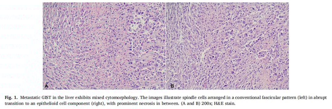 伊马替尼治疗后GIST肝转移灶标志物消失?KIT基因检测成诊断关键 1 图片