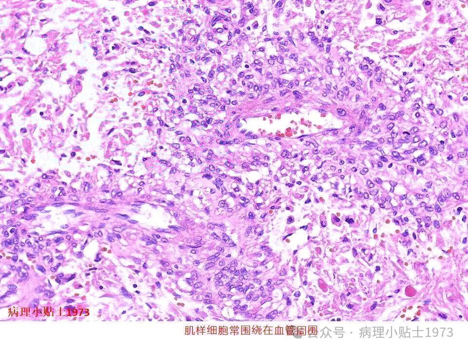 肾脏血管平滑肌脂肪瘤(AML)是什么?一文详解其症状、诊断与TSC基因突变 6 图片