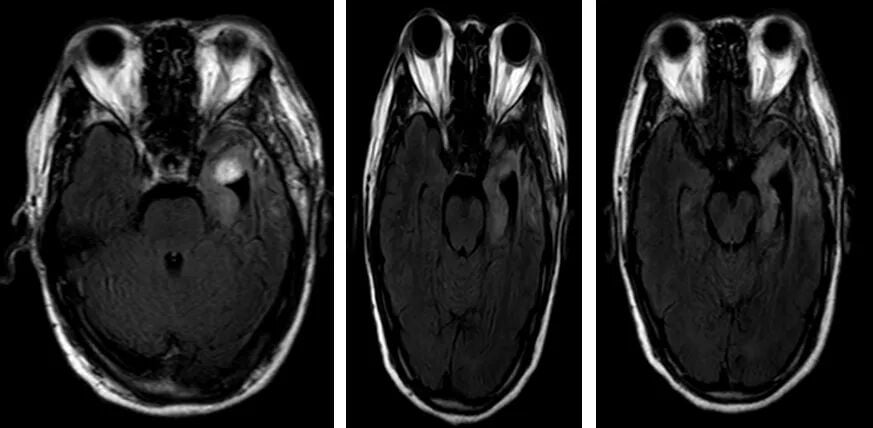 复发胶质母细胞瘤新选择:替尼泊苷联合贝伐珠单抗治疗成功病例解读 4 图片